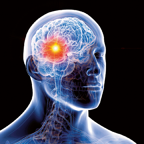 Ataxia