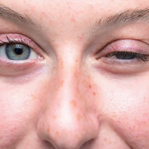Myasthenia Gravis