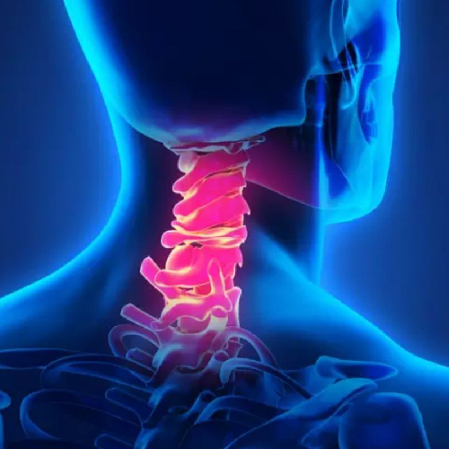 Myelopathy
